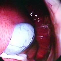 Endoscopia