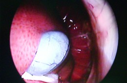 Endoscopia